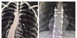 Nueva intervención de columna vertebral