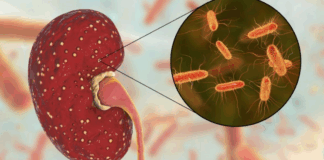 Síndrome Urémico Hemolítico: en Argentina se registran unos 300 casos anuales
